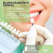 Blanqueamiento Dental